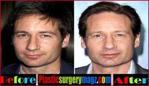David Duchovny Plastic Surgery Before and After