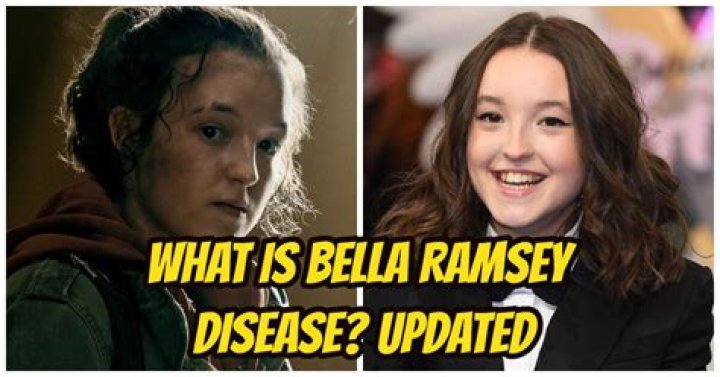 Does Bella Ramsey Have Fetal Alcohol Syndrome? What’s Wrong With the Face of the Last of Us Cast?