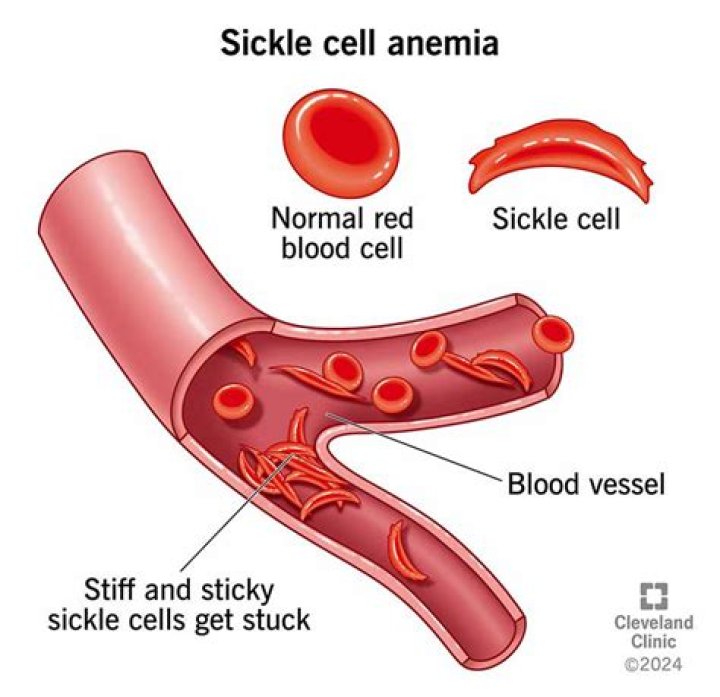 How does sickle cell anemia compare to hemophilia?