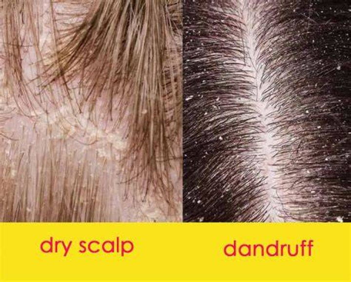 Is dandruff from dry scalp?
