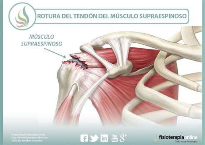 ¿Qué es la rotura del tendon supraespinoso?