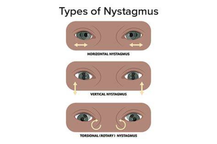 What are the different types of nystagmus?