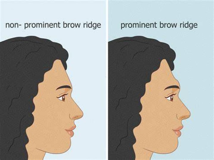 What causes prominent brow ridge?