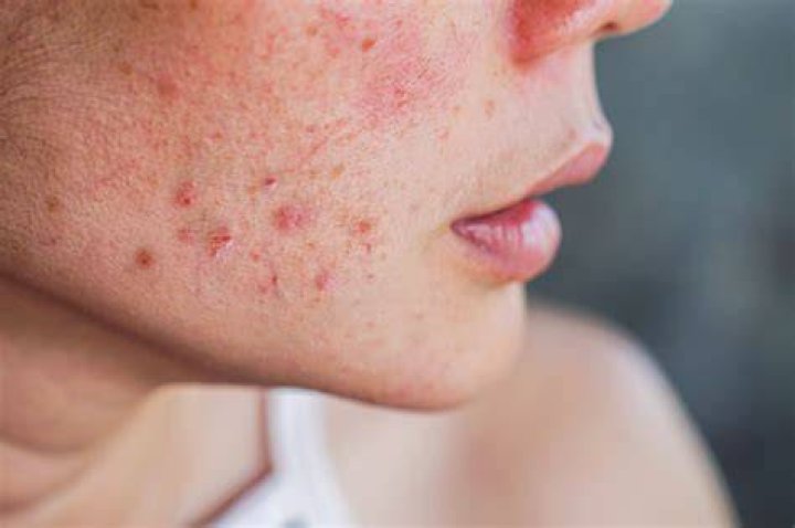 What does a bacterial infection of the skin look like?