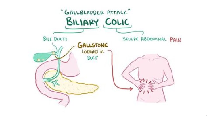 What does gallbladder colic feel like?