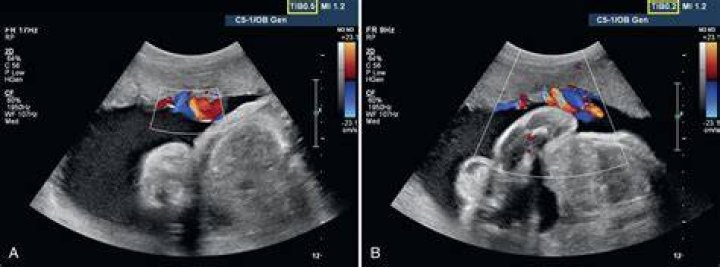 What does MI and TIB mean on an ultrasound?