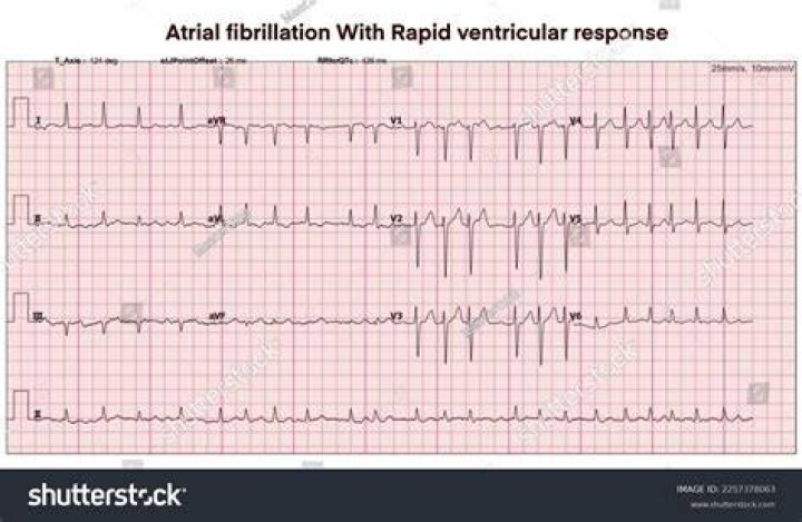 What heart rate is RVR?